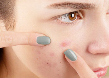 ব্রণ পেকে গেলে কী করবেন