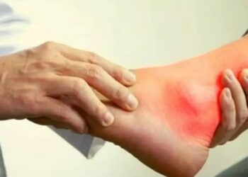 বিশ্বব্যাপী ইউরিক অ্যাসিডে আক্রান্ত রোগীর সংখ্যা দিনকে দিন দিন বেড়েই চলেছে। আর আমাদের দেহে যখন ইউরিক অ্যাসিডের মাত্রা বেড়ে যায়, তখন তা